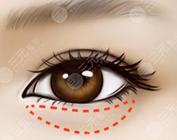 外切眼袋恢復(fù)過程圖