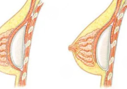 殷初陽隆胸手術(shù)好嗎?