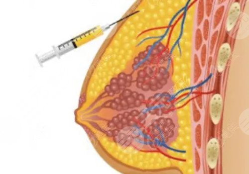 殷初陽隆胸手術(shù)好嗎?