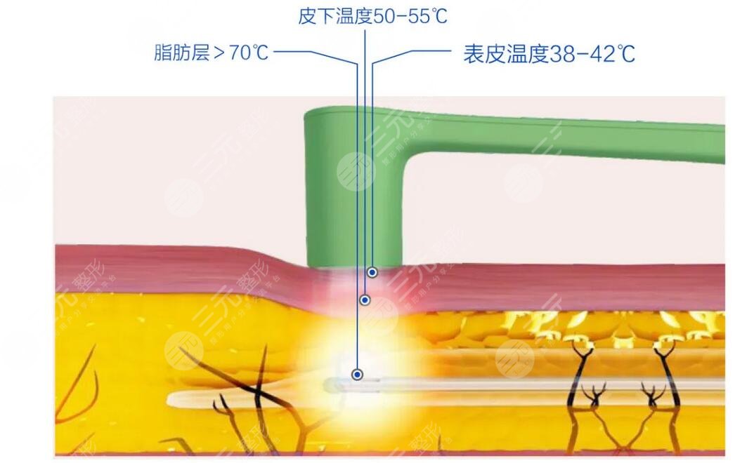 美迪邁黃金微針和半島區(qū)別