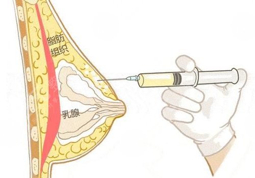注射隆胸怎么取出來？