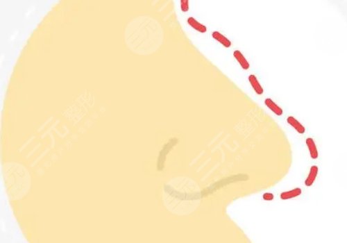 硅膠隆鼻好不好？