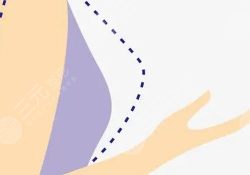 威寧之星假體隆胸價(jià)格是多少？