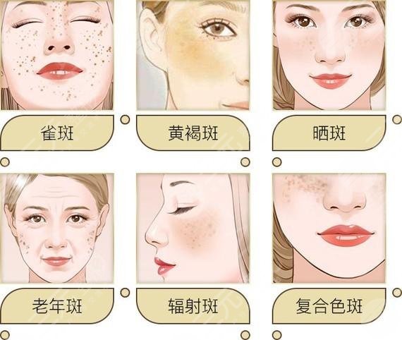 斑的形成原因及分類