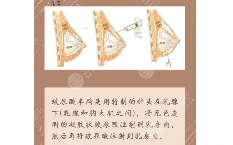 注射隆胸怎么取出來？