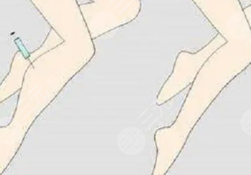 注射瘦腿會反彈嗎？