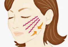 小拉皮手術(shù)全過程，小拉皮手術(shù)的優(yōu)勢在哪里！