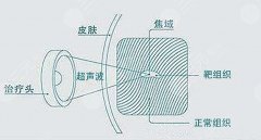 超聲炮的價格是多少?有哪些因素影響?