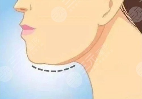 輪廓固定的危害