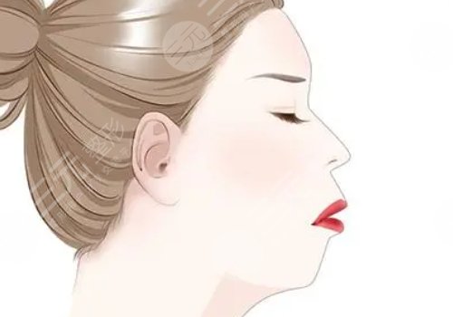 下顎線提升整形有什么做法？