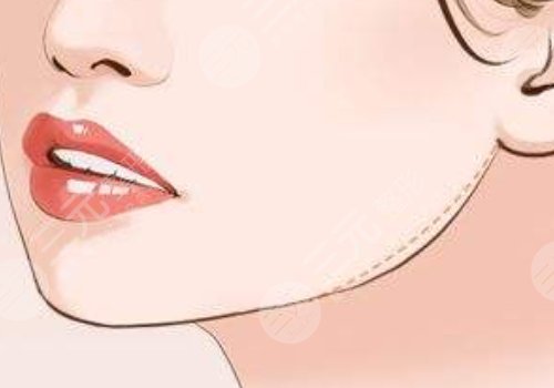 下顎線提升整形有什么做法？