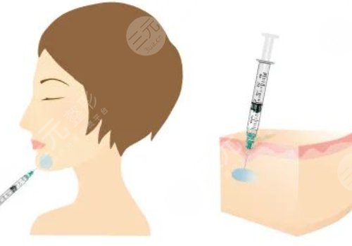 下顎線提升整形有什么做法？