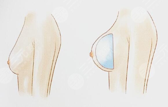 假體豐胸腋下切口多久能長好?