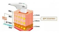 做超聲炮能維持多久？做超聲炮后的適應(yīng)癥和注意事項(xiàng)你可能需要知道！