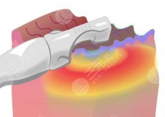 熱瑪吉和超聲炮的區(qū)別？原理、使用方法、適用人群等幫你找到答案！