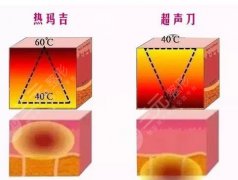 超聲炮好還是熱瑪吉好？區(qū)分一下選擇更加適合自己的項(xiàng)目！