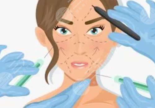 什么是面部輪廓提升針?