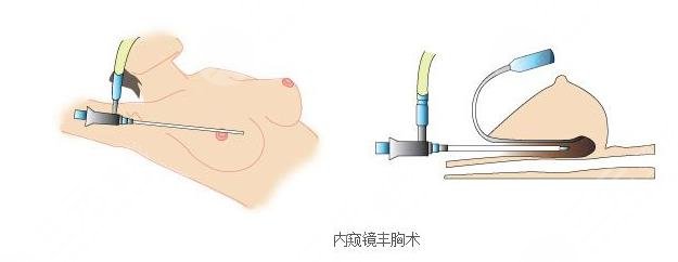 內(nèi)窺鏡隆胸