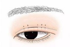 吸雕雙眼皮怎么樣？操作步驟、恢復(fù)期、以及護(hù)理方法分享！