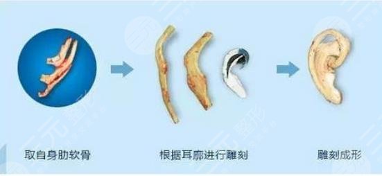 外耳再造手術需要多少費用？價格表大全，匯總分享！