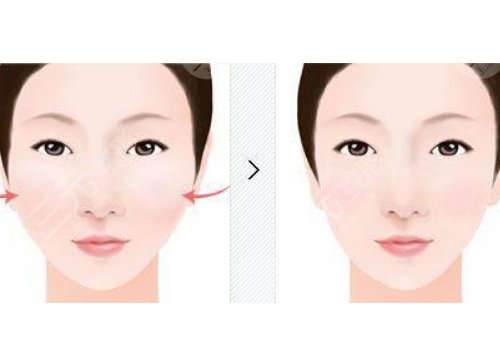 面部輪廓固定針能維持多久？作用如何？