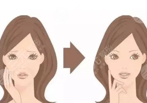 臉部下垂做超聲刀好還是拉皮好呢？