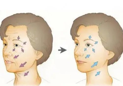 臉部下垂做超聲刀好還是拉皮好呢？