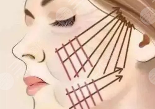 臉部下垂做超聲刀好還是拉皮好呢？