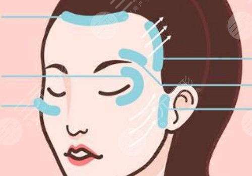 輪廓提升多久有效果？