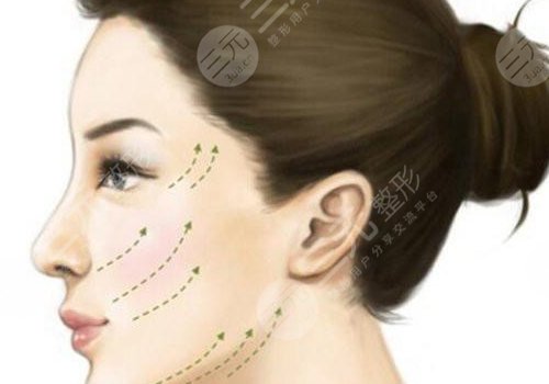 輪廓提升多久有效果？