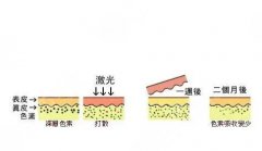 激光美白有用嗎？激光美白的原理、操作流程、祛斑價格一覽！