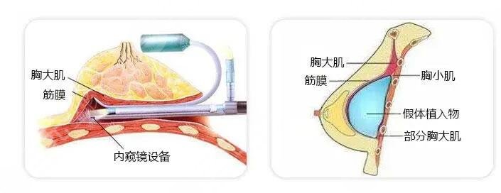 內(nèi)窺鏡隆胸的技術(shù)優(yōu)勢