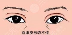 雙眼皮修復(fù)價(jià)格多少？雙眼皮修復(fù)恢復(fù)期多久、風(fēng)險(xiǎn)大小可了解！