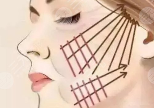 做完線雕多久可以恢復(fù)？