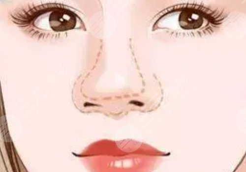 顧新安做鼻子怎樣？