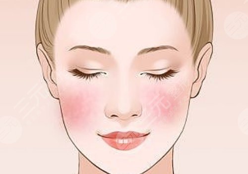 豐顏玻尿酸多久能消腫？