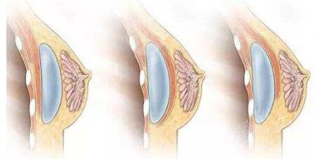 傲諾拉假體材料品牌信息