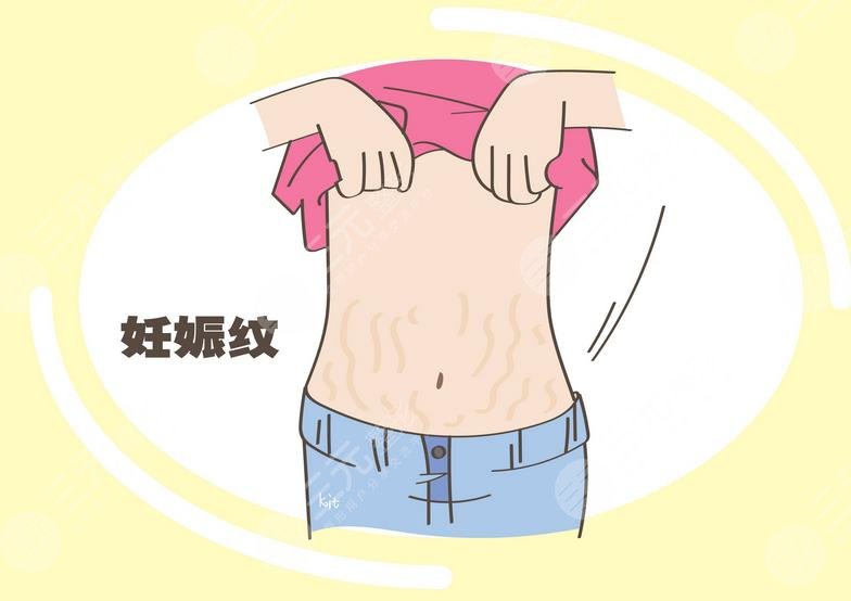 妊娠紋怎么消除