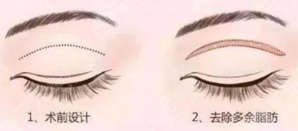 雙眼皮手術(shù)