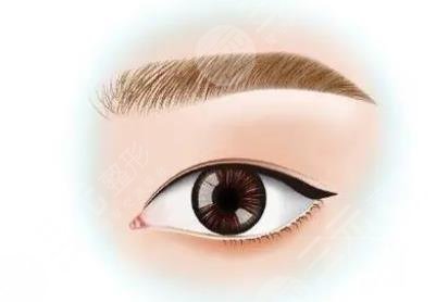 雙眼皮手術(shù)