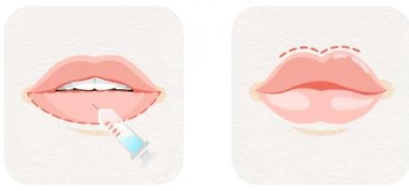 玻尿酸豐唇整形術(shù)怎么樣，多少錢？價格&手術(shù)常識介紹！