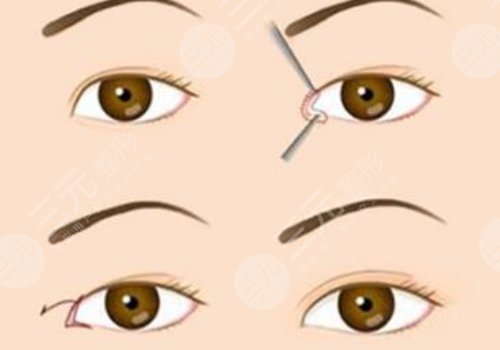 開眼角割雙眼皮恢復(fù)期要多久？