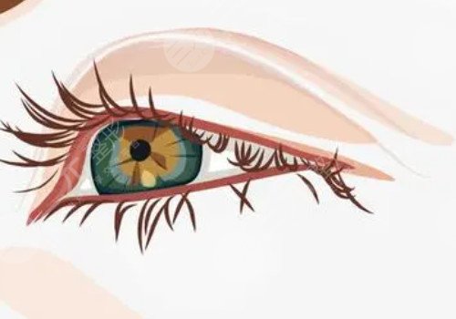 開眼角割雙眼皮恢復(fù)期要多久？