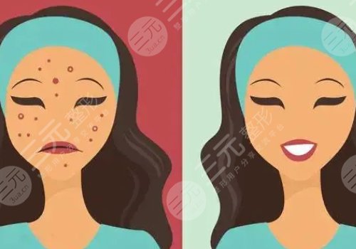 痘印怎么消除？