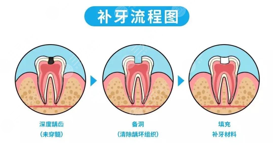 補牙封藥后疼正?常嗎?