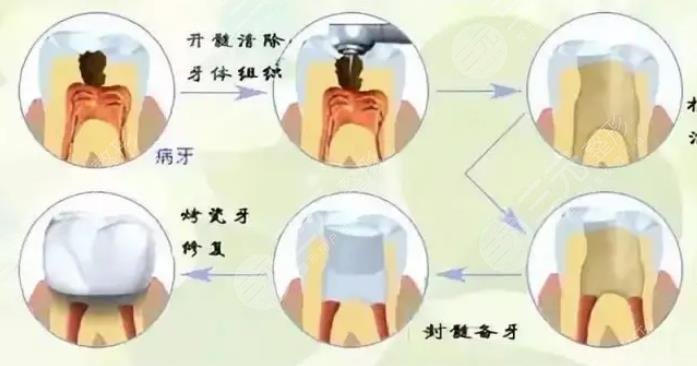 補牙封藥后疼正?常嗎?