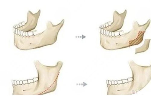 做輪廓手術(shù)多少錢(qián)費(fèi)用是多少？