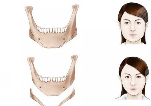做輪廓手術(shù)多少錢(qián)費(fèi)用是多少？