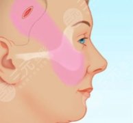 小拉皮切口一般在哪？根據(jù)部位不同切口位置有差別~具體情況分享