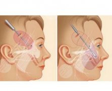 大拉皮手術(shù)恢復(fù)期多少天？大拉皮術(shù)后7個(gè)注意事項(xiàng)要了解！